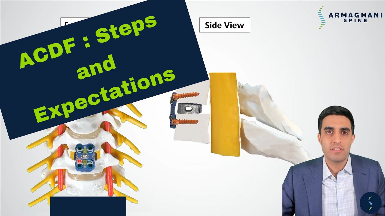 ACDF (Anterior Cervical Diskectomy and Fusion) - What is it? How do you do it? What can I do after?