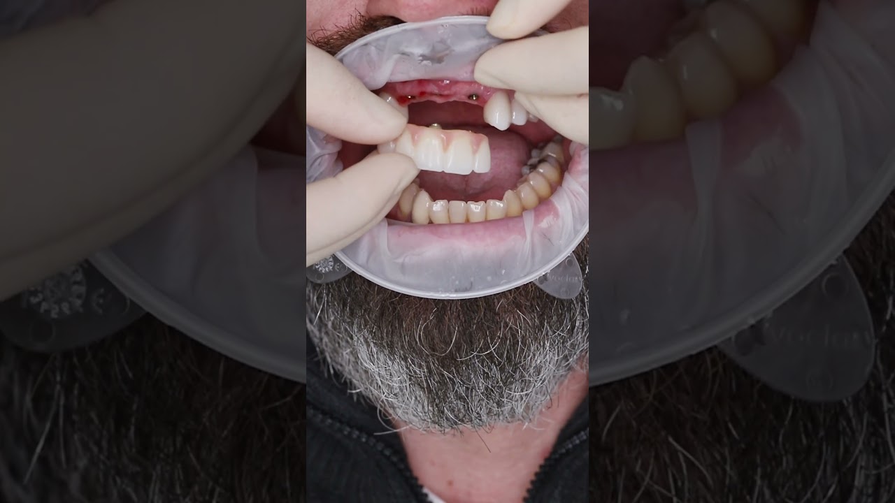 Dental implant’s in Prague #shorts #dentist #dental #implant #veneers #short
