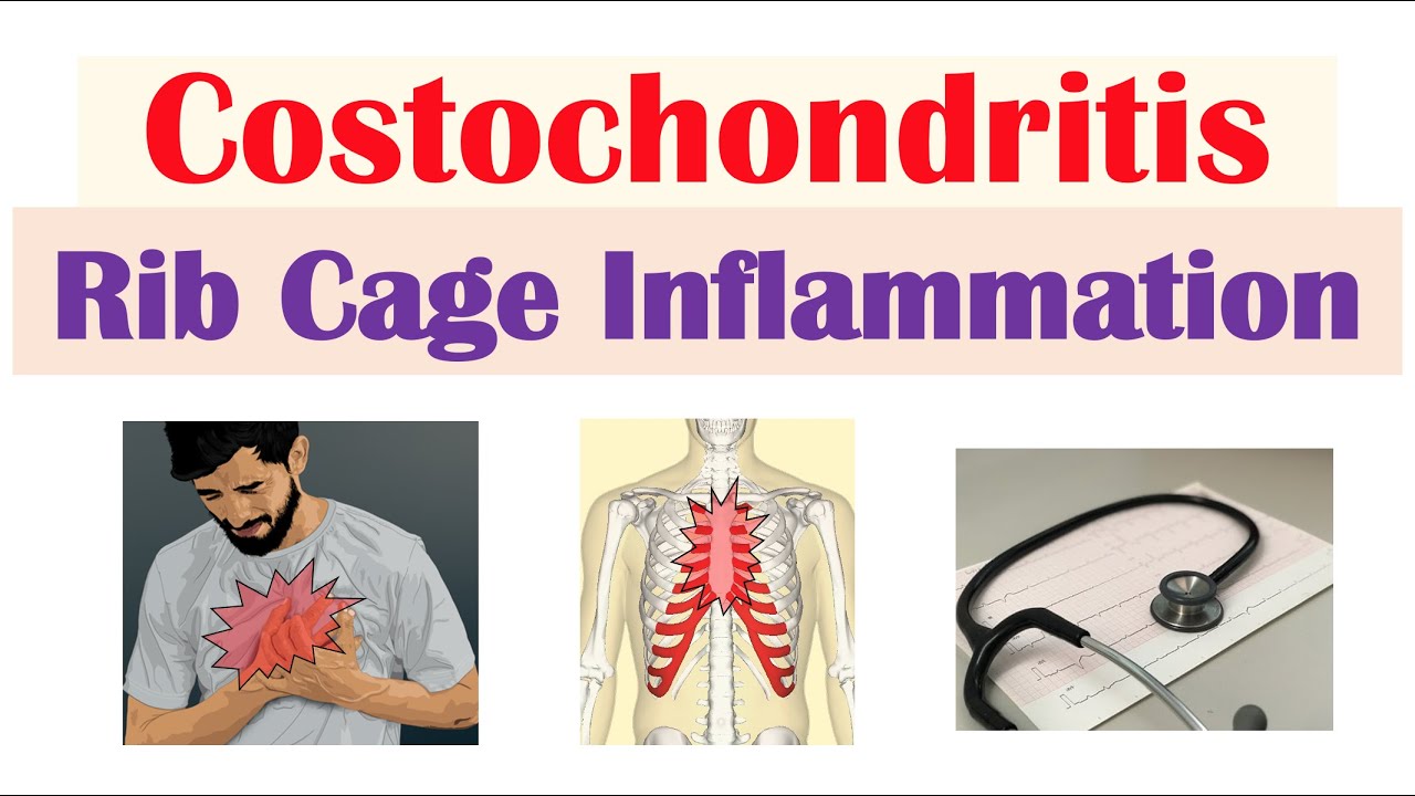 Costochondritis (Rib Cage Inflammation) | Causes, Symptoms, Diagnosis, Treatment