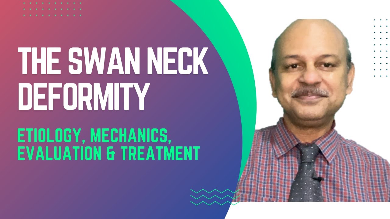 The swan neck deformity: Etiology, pathomechanics, evaluation and treatment - Made clear and simple