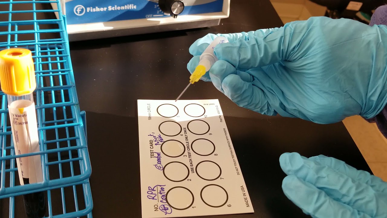 Microbiology: Rapid Plasma Reagin (RPR) Test