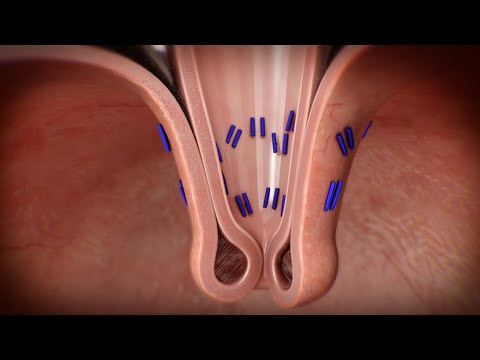 Transoral Incisionless Fundoplication (TIF) Procedure