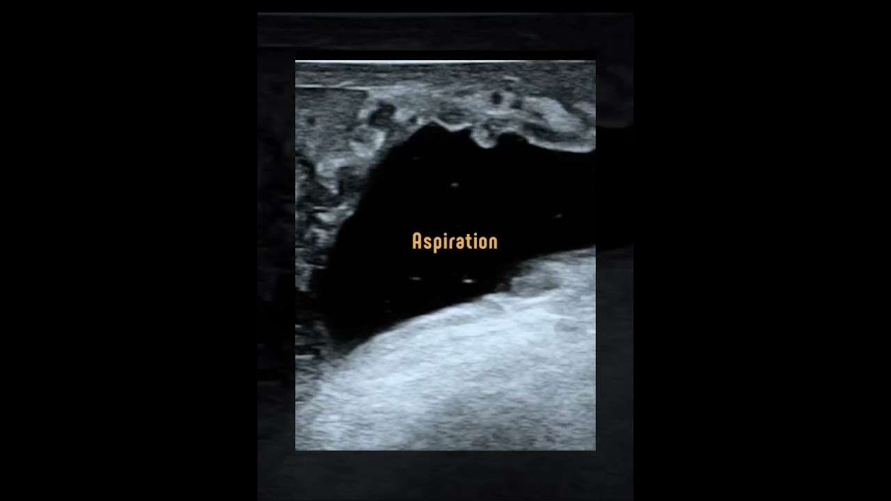 Spermatocele Aspiration Sclerotherapy Doctor Non-Surgical Treatment
