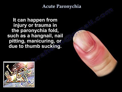 Paronychia - Everything You Need To Know - Dr. Nabil Ebraheim