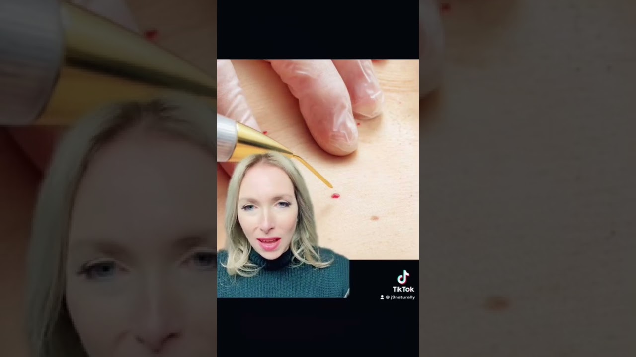 Do You Have These Red Spots On Your Skin? Cherry Angiomas #CherryAngiomas #shorts