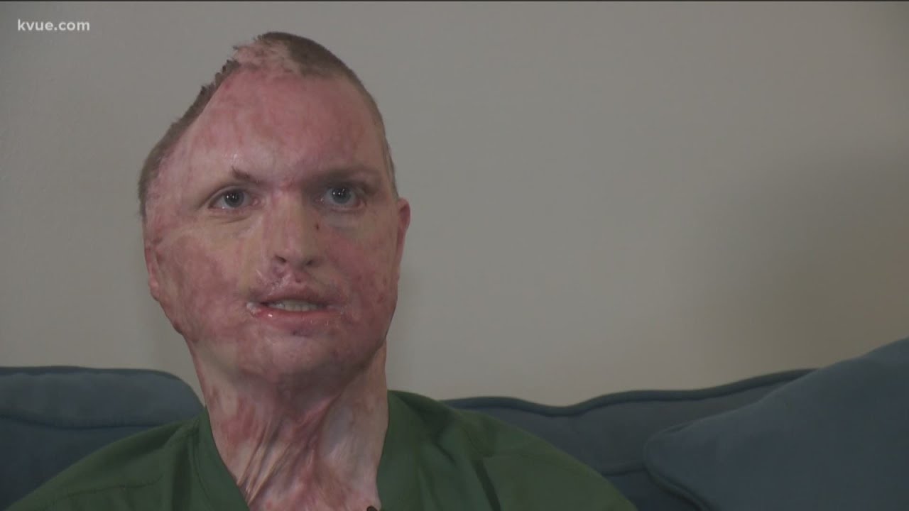 4th Degree Burns: Signs, Symptoms, & Treatment