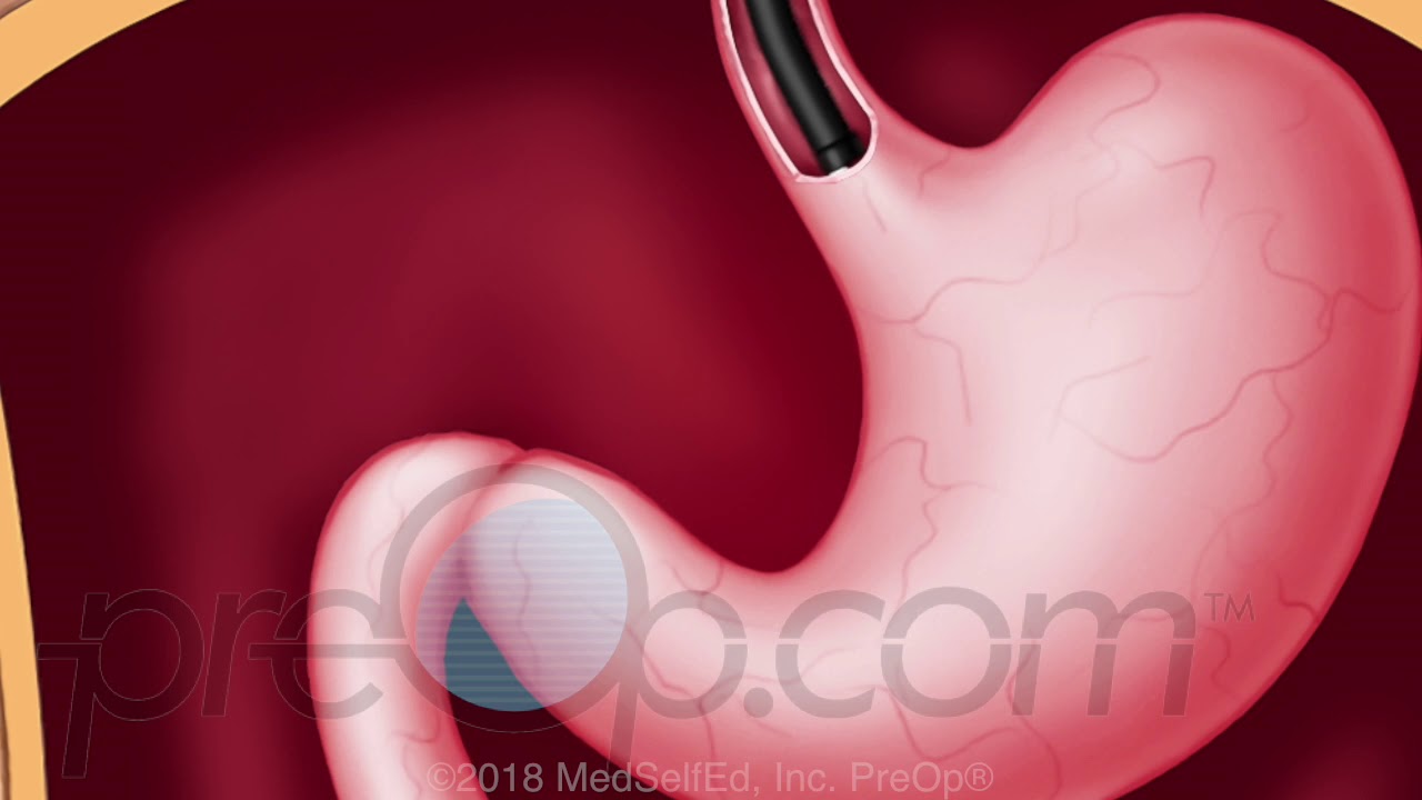 Upper GI Endoscopy, EGD - PreOp Surgery Patient Education - Engagement