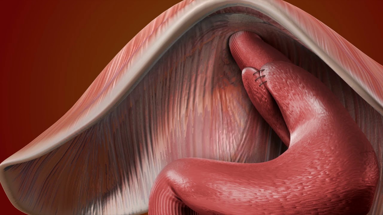 Fundoplication