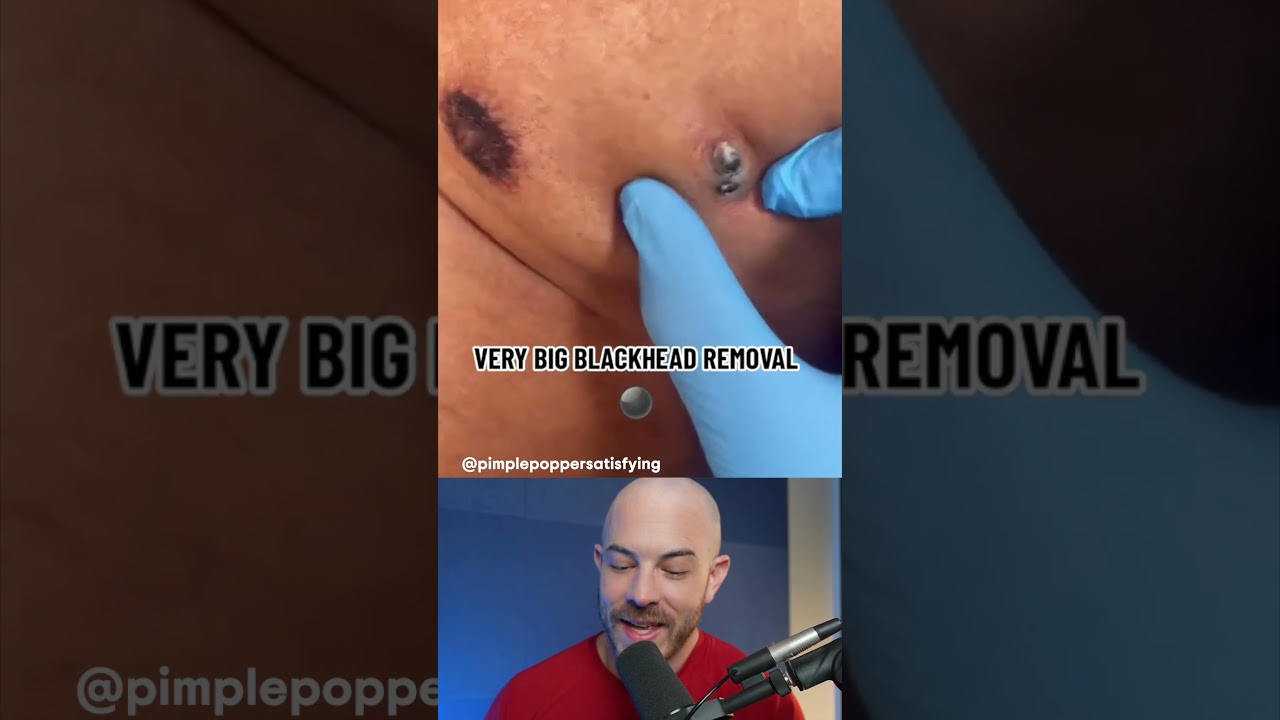 GIANT blackhead removal! #dermreacts #blackheadremoval #acneremoval
