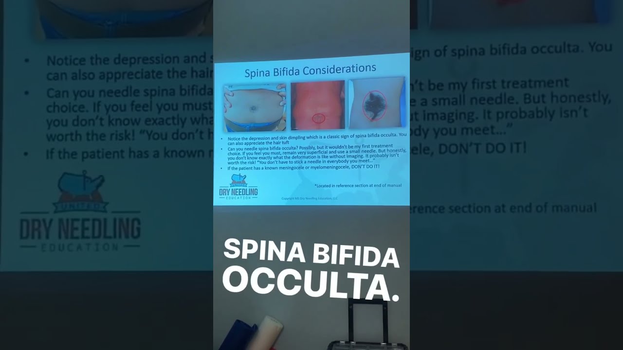 Spina Bifida Occulta. In a class of six, two sacral dimples!