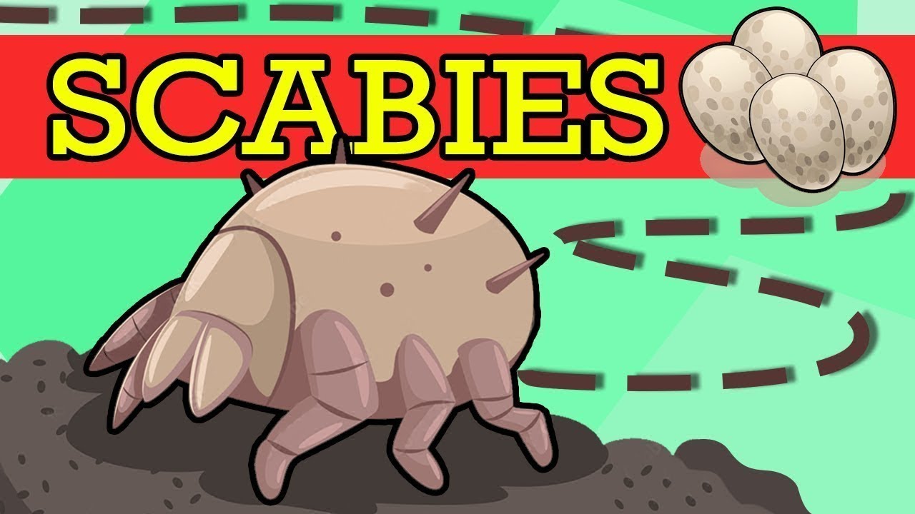 SCABIES, Causes, Signs and Symptoms, Diagnosis and Treatment.
