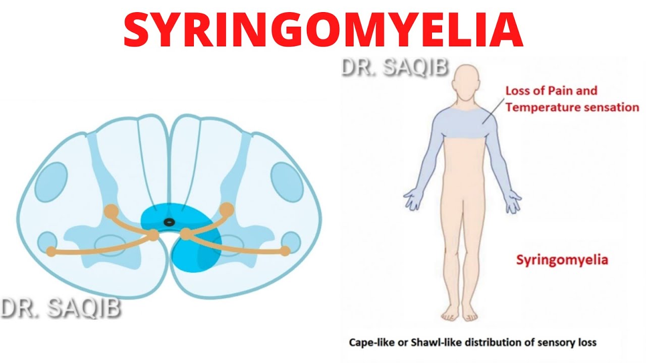 Syringomyelia