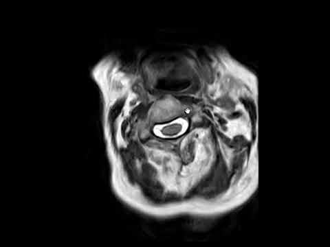 Klippel-Feil syndrome (KFS)