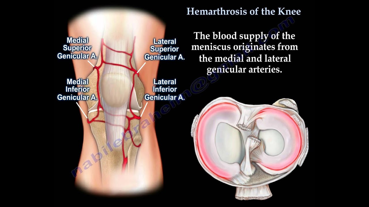 Hemoarthrosis of the knee,Knee swelling .Everything You Need To Know - Dr. Nabil Ebraheim