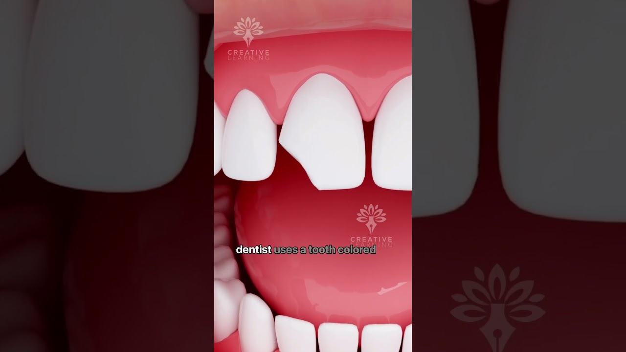 How Does Bonding Fix a Chipped Tooth #shorts #tooth - Creativelearning3d