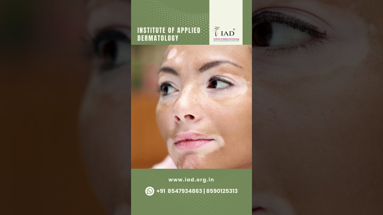 White patches on face | pityriasis alba | children skin diseases | atopic dermatitis | IAD