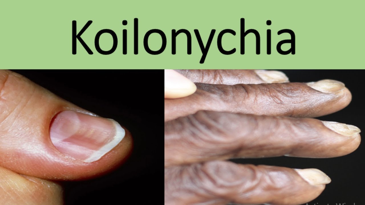 Koilonychia (Spoon Nails): Causes, Diagnosis, Treatment, Clinical Sign