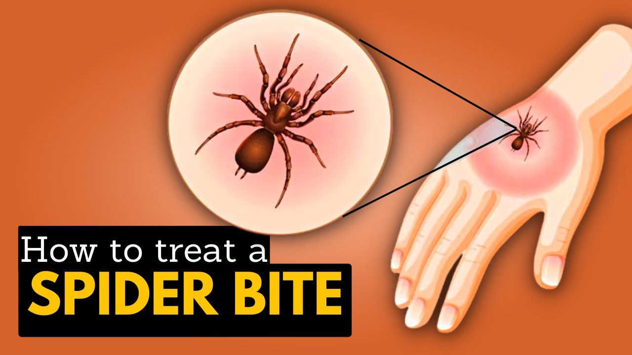 How to Treat A Spider's Bite?