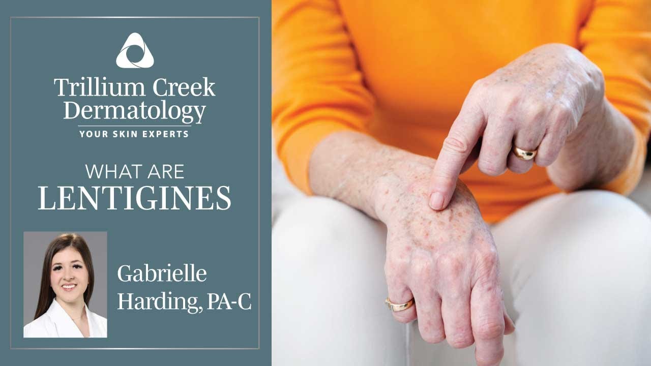 What are Lentigines?