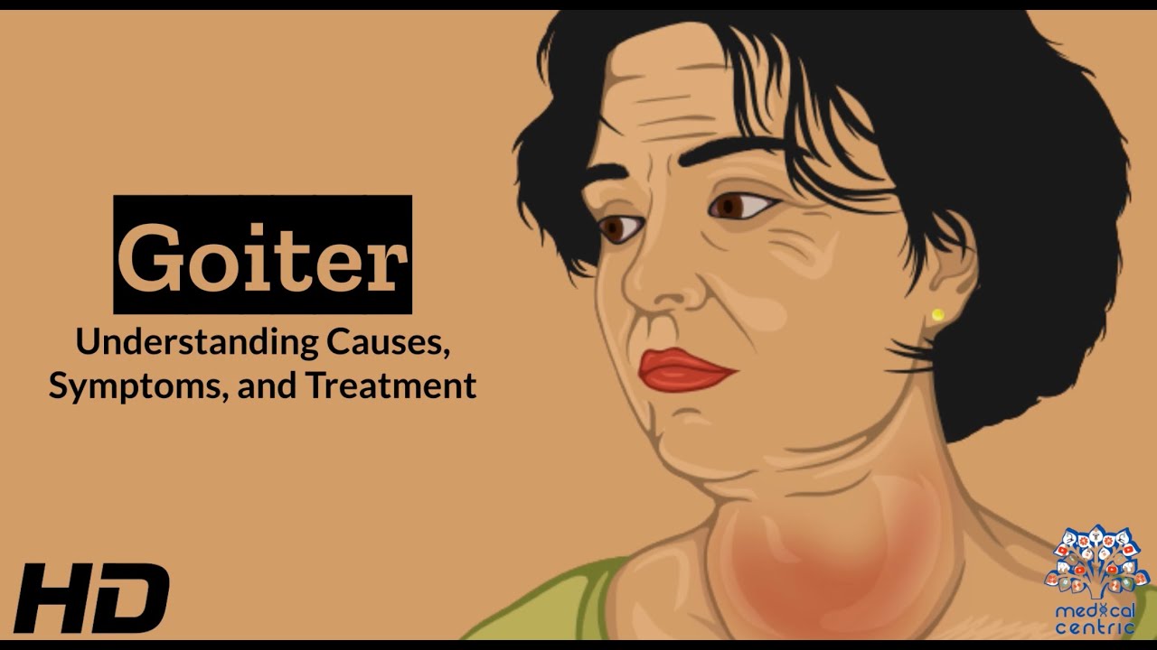 Thyroid Troubles: Navigating Goiter - Causes, Symptoms, and Treatment Explained