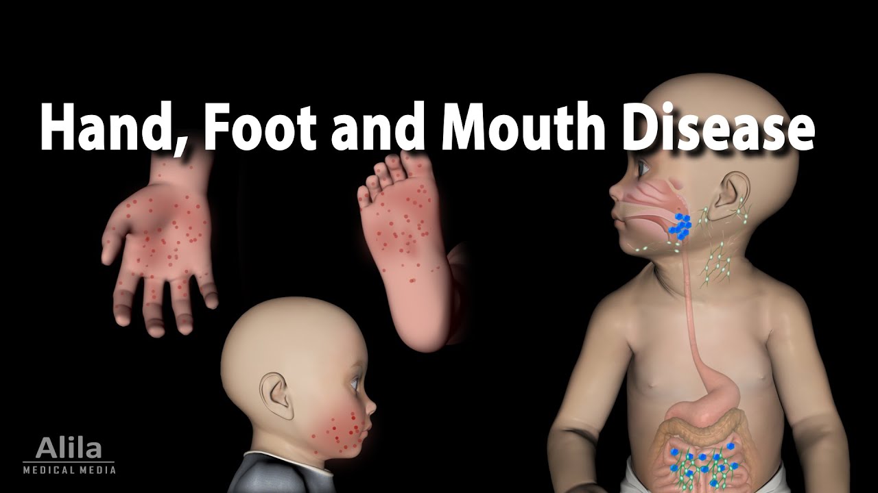 Hand Foot and Mouth Disease, Animation