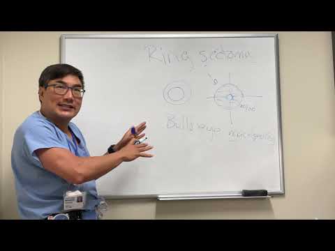 Ring scotoma
