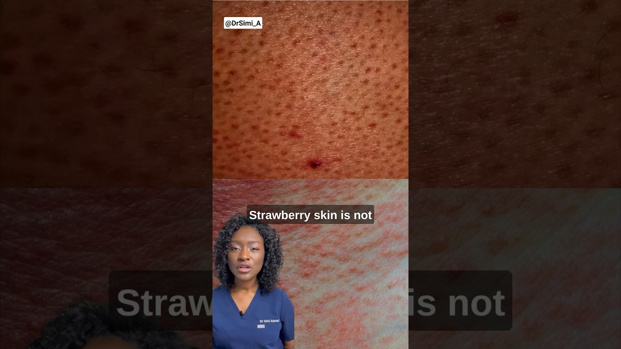 Hidden Causes Of Strawberry Skin + Products | Causes Of Red Dots On Legs