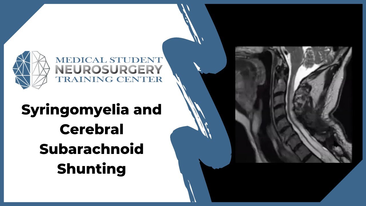 Syringomyelia and Cerebral Subarachnoid Shunting