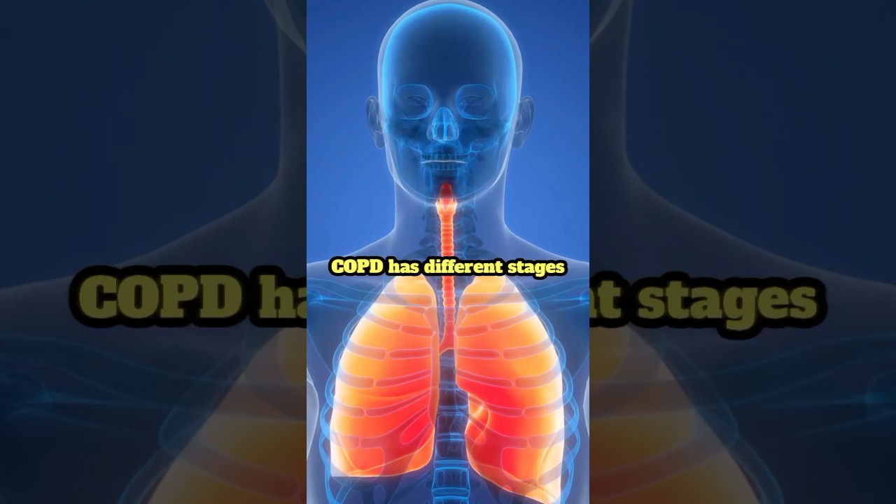 COPD stages explained #copd #lungdisease #pulmonaryrehabilitation