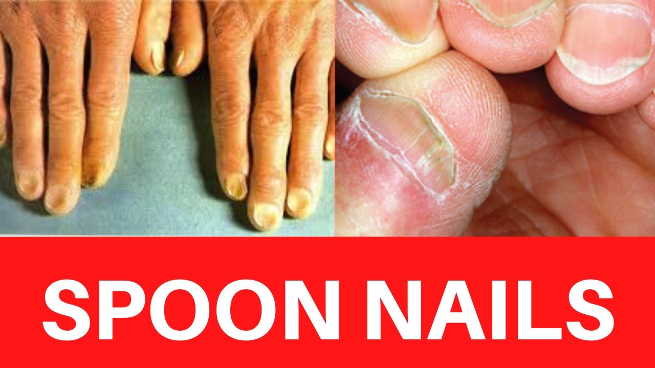 SPOON NAILS? : Koilonychia Causes, Treatment, Symptoms, Iron deficiency Anemia, Cure, Prevention