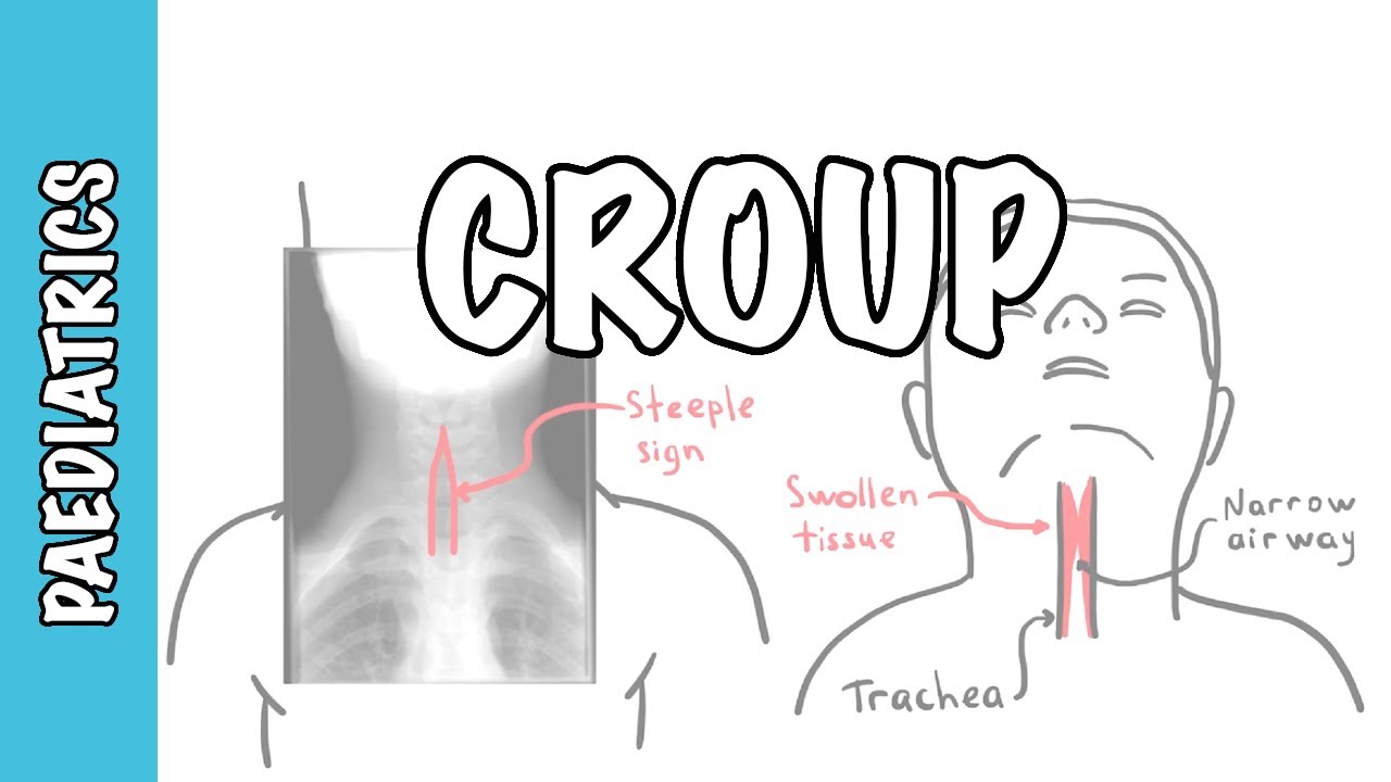 What is Croup (larynotracheobronchitis) - symptoms, pathophysiology, investigations, treatment