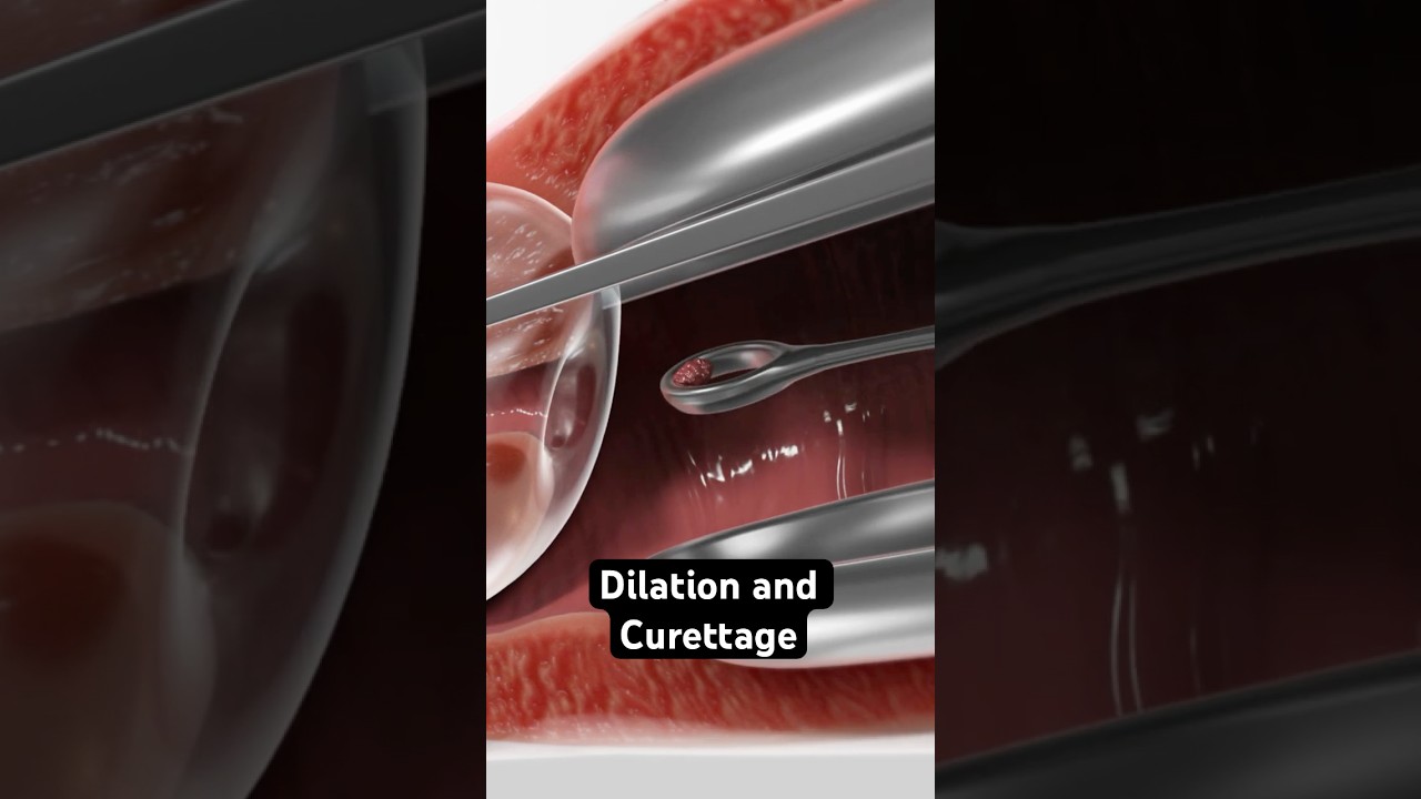 Collecting tissue from the uterus (3D Animation)