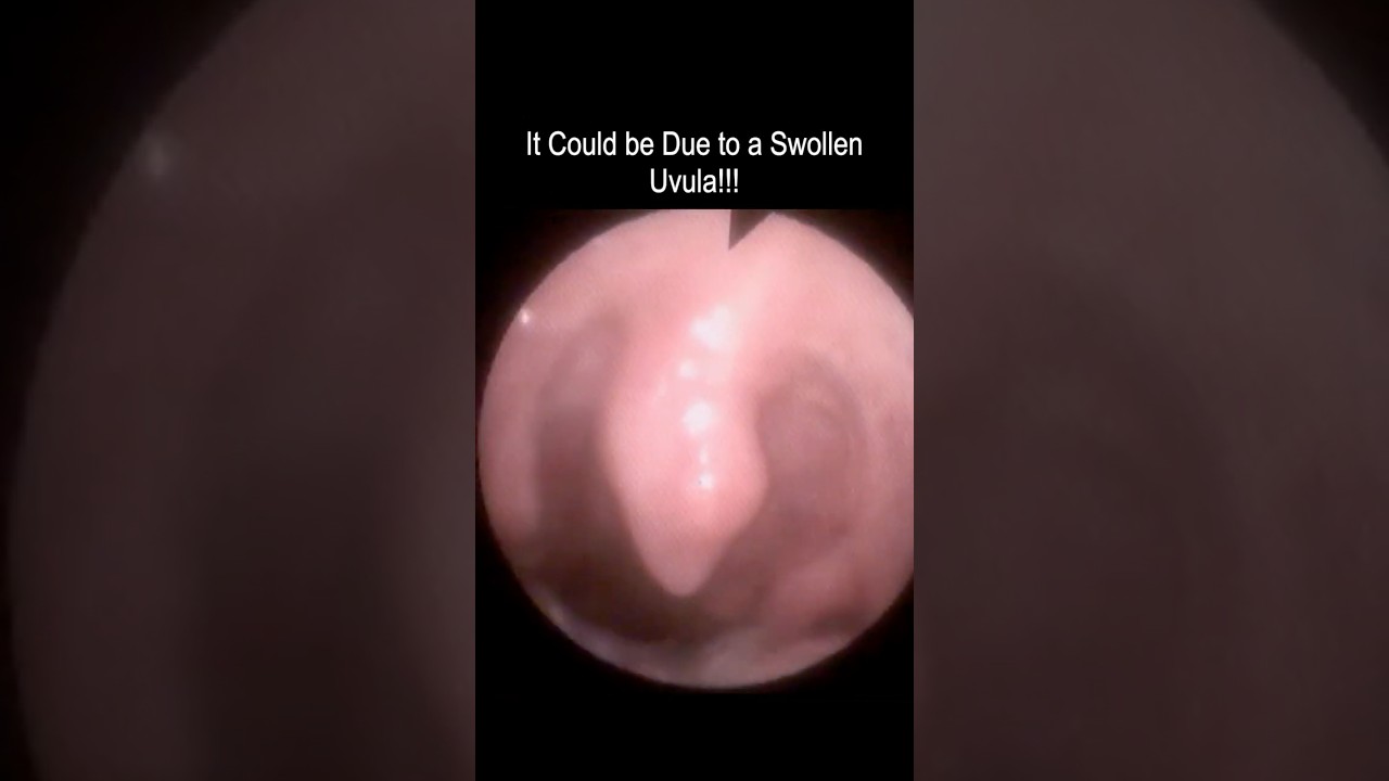Swollen Uvula Causing Lump Sensation in Throat #shorts #throatlump #globus @fauquierent