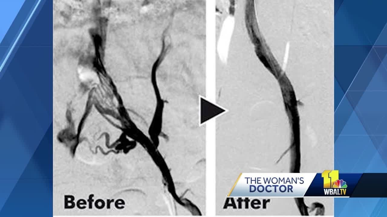 Doctor explains May-Thurner Syndrome