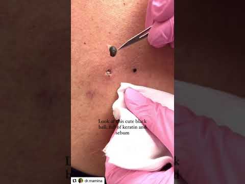 Dilated Pores of Winer
