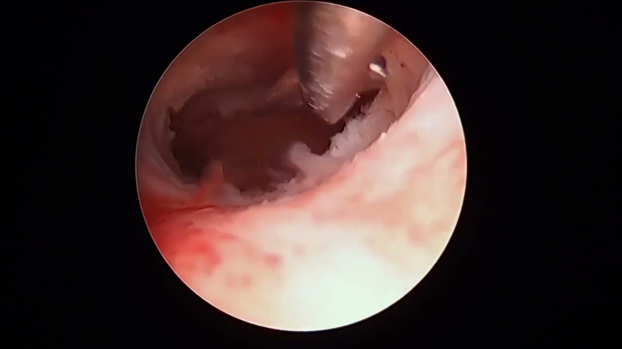 Hysteroscopic lysis of adhesions for Asherman Syndrome