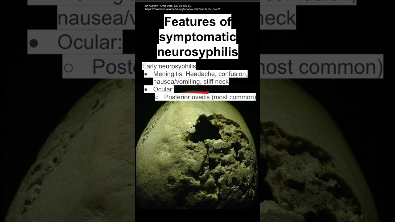 Features of symptomatic neurosyphilis