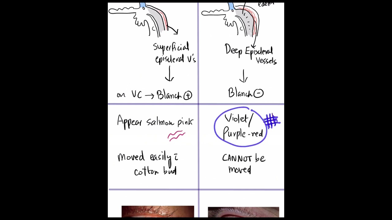 Episcleritis vs. Scleritis - Key differences #Shorts #Mustknow