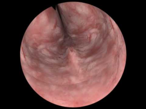 Full TURP procedure prostate resection
