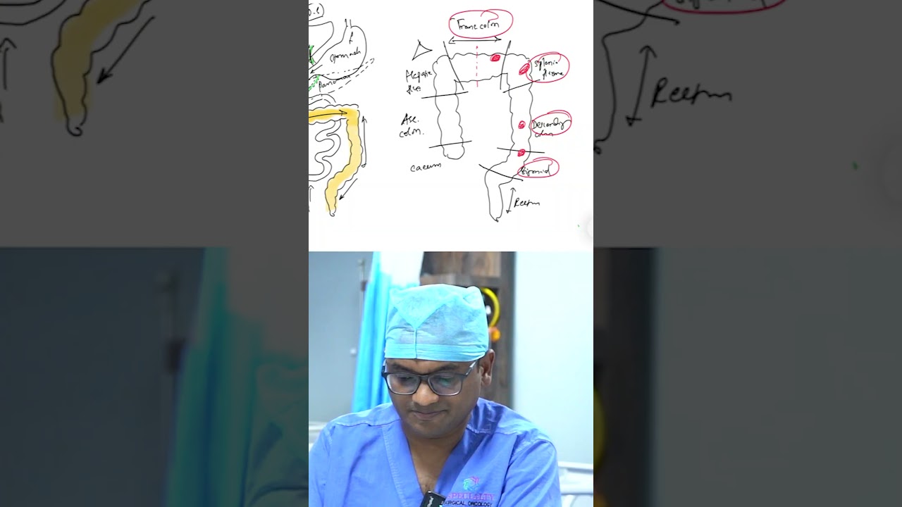 Step-by-Step Left Hemicolectomy: Understanding Colon Cancer Treatment | Dr Praveen Kammar