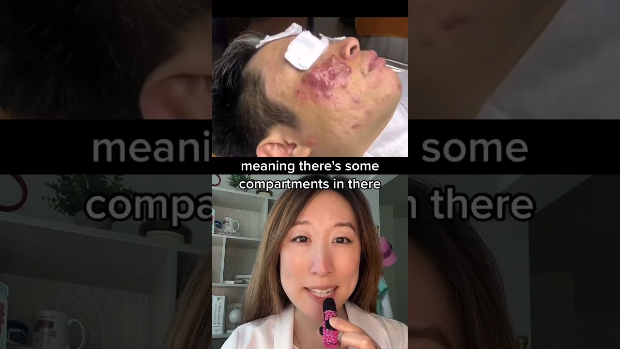 Extracting a nodulocystic #acne plaque - hope they numbed first #dermbypark #shorts
