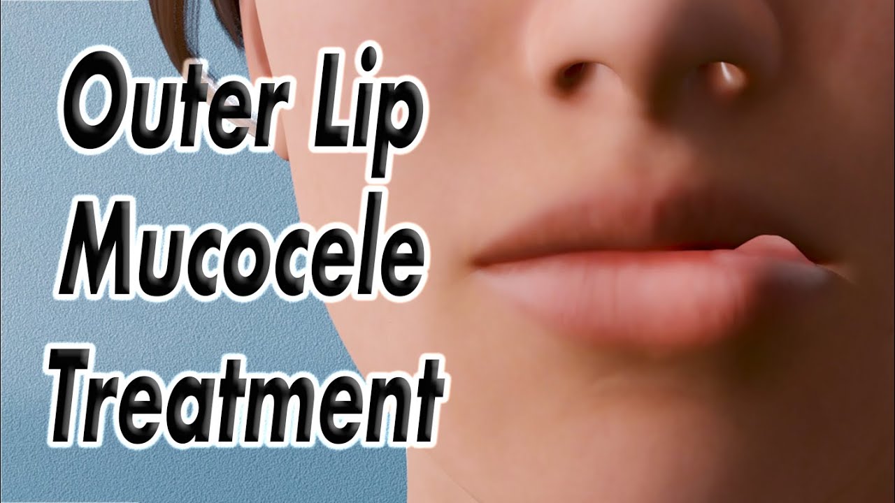 Outer Lip Mucocele (Lip Bump) Surgical Treatment