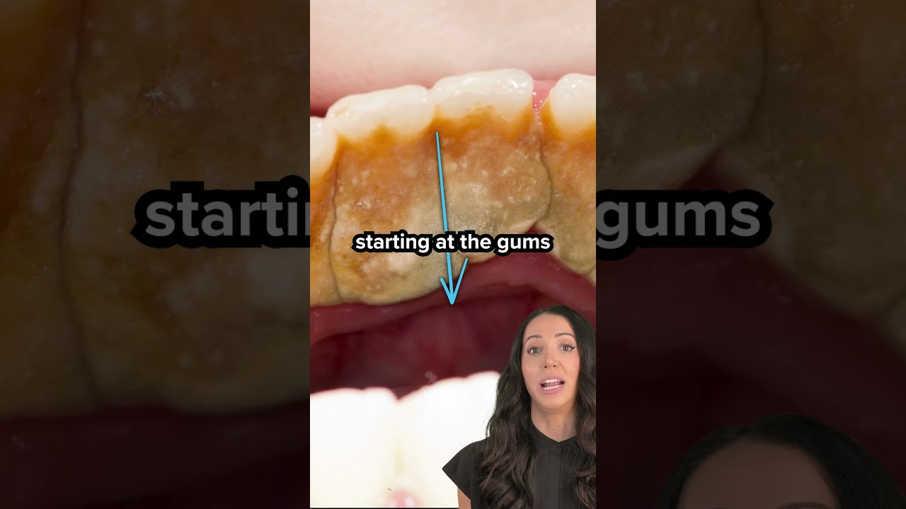 plaque vs tartar on teeth (dental calculus) #shorts