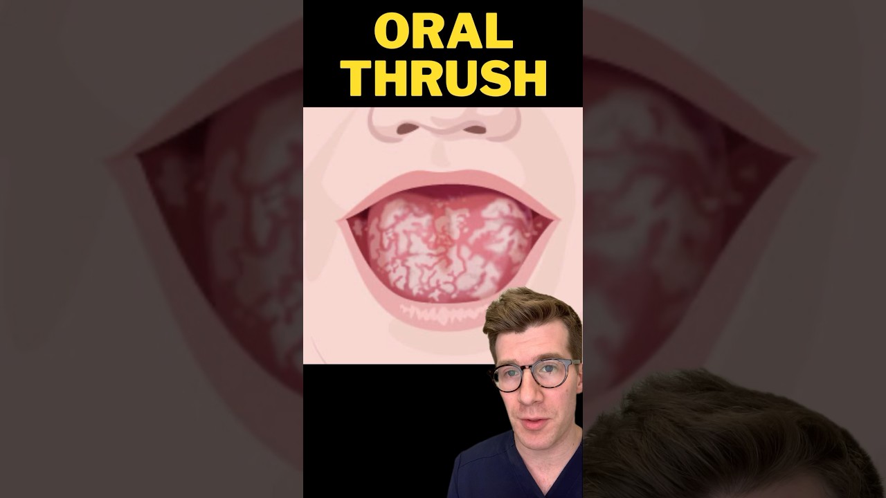 Doctor explains ORAL THRUSH in babies #shorts