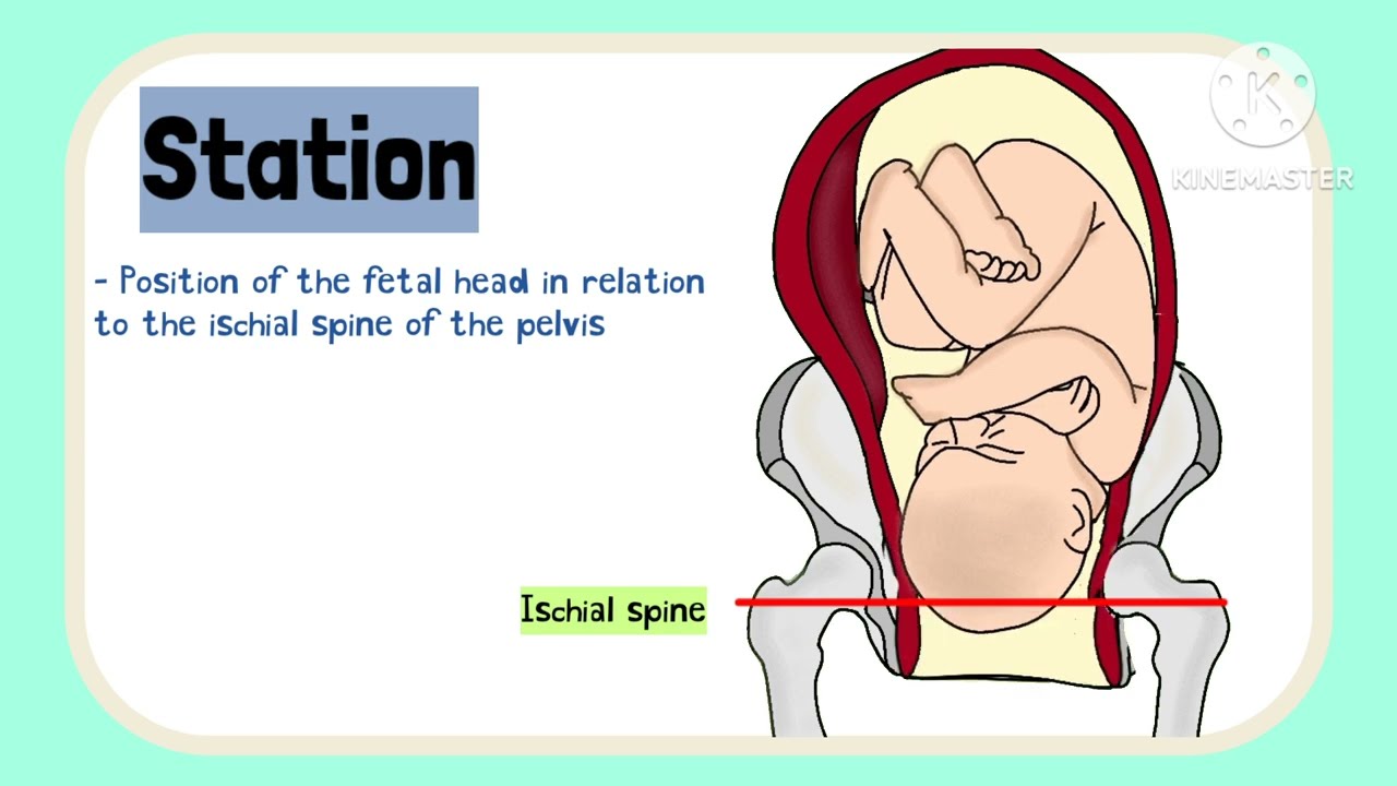 Bishop Score// Induction of labour in pregnancy #Obstetrics