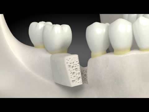 What is a dental bone graft?