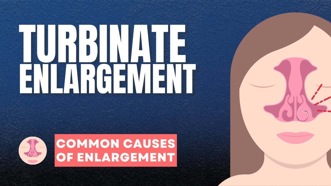 Symptoms of enlarged turbinates