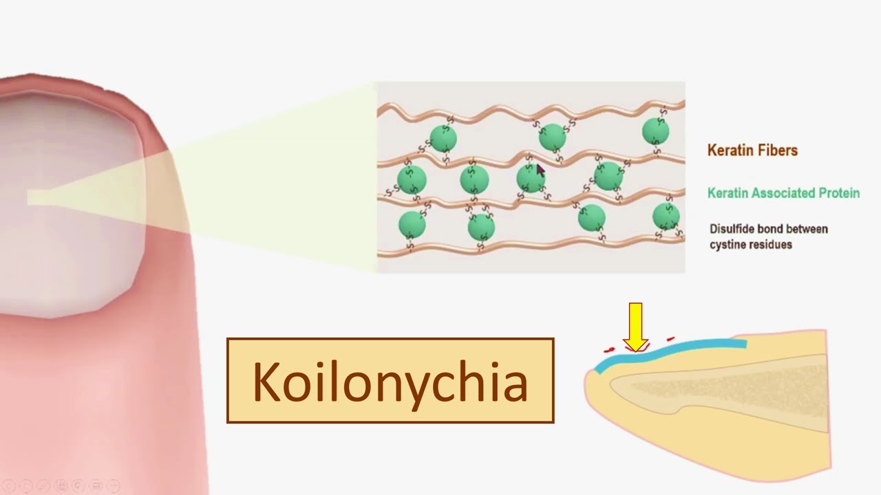 How Koilonychia develops in Iron Deficiency Anemia - Koilonychia (spoon nails) pathogenesis