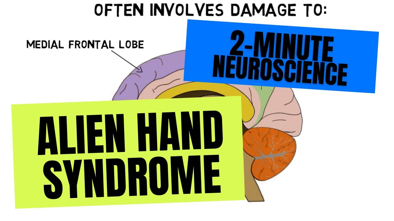 2-Minute Neuroscience: Alien Hand Syndrome