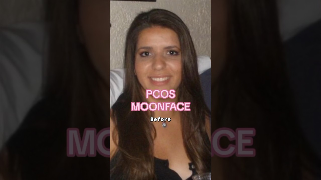 Want to know how I got rid of my PCOS Moonface? #pcos